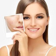 [FORUM] Kalau pake cuka apel untuk bekas jerawat ampuh gak ya?