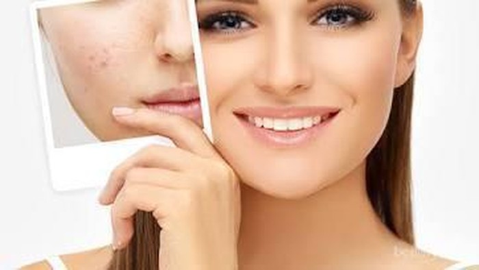 [FORUM] Kalau pake cuka apel untuk bekas jerawat ampuh gak ya?