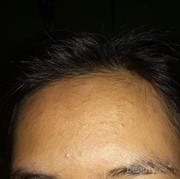 Cara ngilangin bruntusan pake cara alami gimana sih?