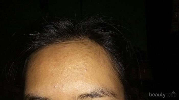 Cara ngilangin bruntusan pake cara alami gimana sih? Cara ngilangin bruntusan pake cara alami gimana sih?