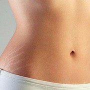 [FORUM] Masih remaja, kenapa aku ada stretch mark?