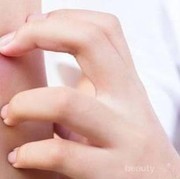 [FORUM] Cara hilangkan noda bekas gigitan nyamuk