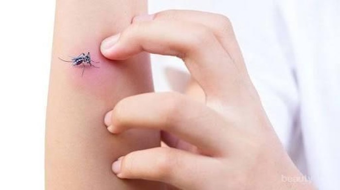 [FORUM] Cara hilangkan noda bekas gigitan nyamuk