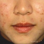 [FORUM] Pernah ada yang berhasil menghilangkan bekas jerawat ga? Pakai apa ya?