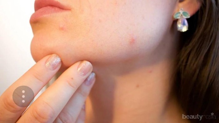 [FORUM] Gimana Ngilangin Bekas jerawat yang Membandel