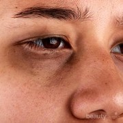 [FORUM] Minta saran buat mengurangi kantong mata setelah begadang dong, ladies