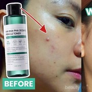 [FORUM] Review! Inilah hasil pemakaian Some By Mi Miracle Toner sebulan!