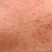 [FORUM] Duh! Beruntusan di Dahiku Nggak Pernah Sembuh deh!