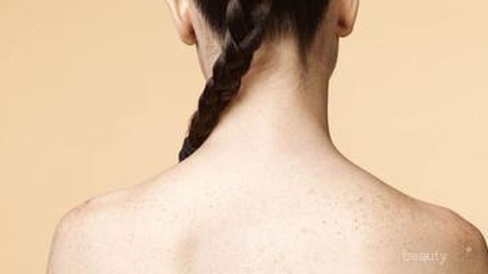 [FORUM] Ampuh! Hilangkan Jerawat di Punggung Selama 3 Minggu