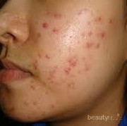 [FORUM] sist, mau nanya skin care yg cocok untuk kulit berminyak & berjerawat apa ya?