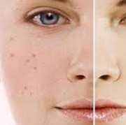 [FORUM] Skin Care untuk Menghilangkan Bekas Jerawat