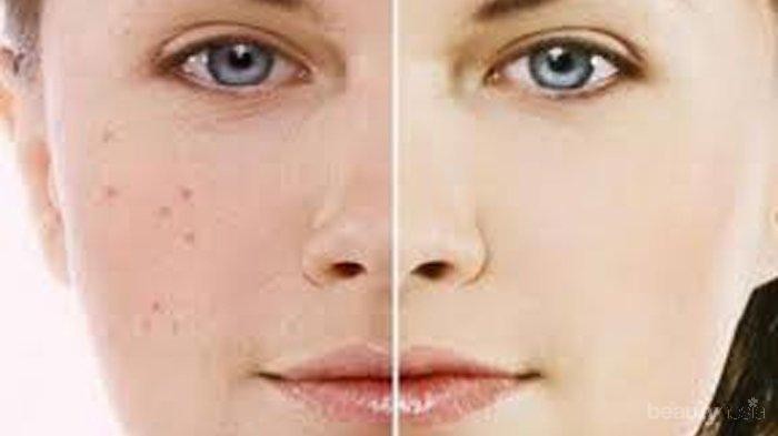 [FORUM] Skin Care untuk Menghilangkan Bekas Jerawat