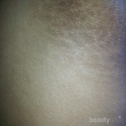 #FORUM Cara atasi strechmark