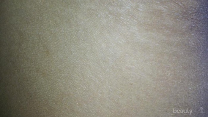 #FORUM Cara atasi strechmark