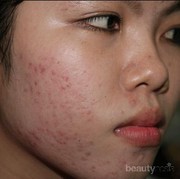 [FORUM] Ada yang ngalamin, stop perawatan dokter jadi jerawatan?