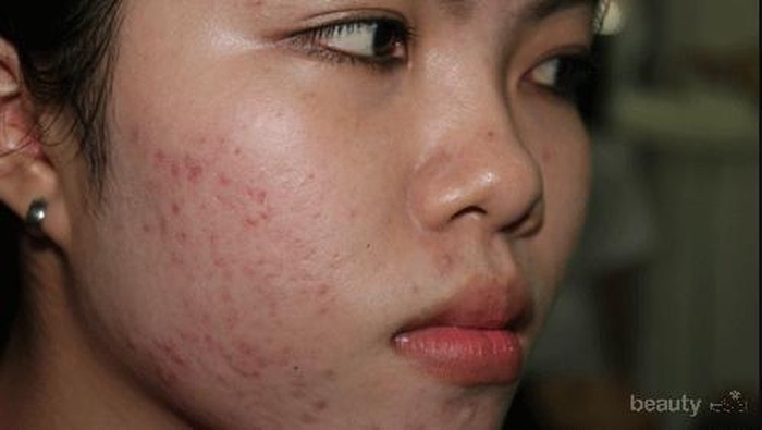 [FORUM] Ada yang ngalamin, stop perawatan dokter jadi jerawatan?