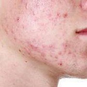 [FORUM] Adakah temen yang berjerawar tapi ga cocok teatree, greentea, wardah, acnes, atau envygreen?
