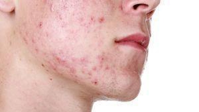 [FORUM] Adakah temen yang berjerawar tapi ga cocok teatree, greentea, wardah, acnes, atau envygreen?