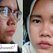 [FORUM] Mitos atau Fakta, Setelah Menikah Jerawat di Wajah akan Hilang?
