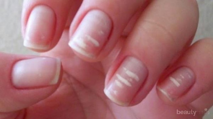 [FORUM] Pernah denger ga mitos kalo putih-putih di kuku pertanda ada yang suka?