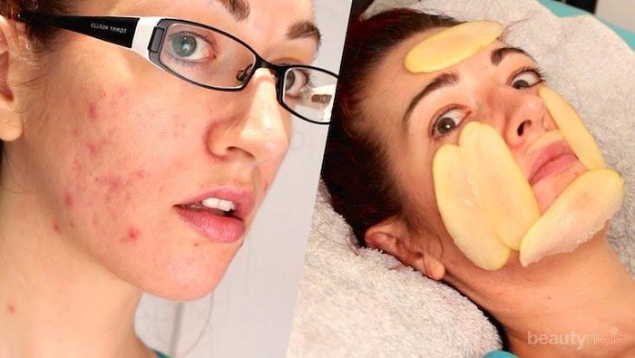 Jerawat Batu Merusak Penampilanmu? Yuk, Hilangkan dengan Cara Mudah Ini Ya Ladies!