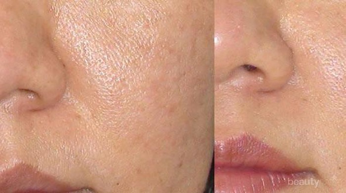 [FORUM] Kenapa Pori-pori Wajah Susah Dikecilkan?