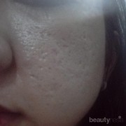 [FORUM] Review treatment atau produk yang bisa ngilangin bopeng dan pori-pori besar