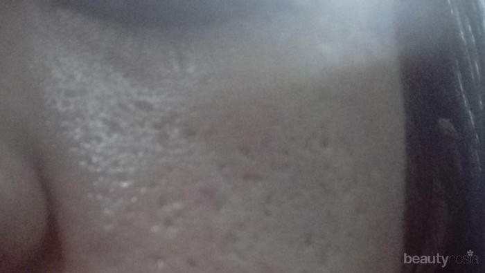 [FORUM] Review treatment atau produk yang bisa ngilangin bopeng dan pori-pori besar