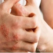 [FORUM] Teman-Teman, Kasih Tips untuk Merawat Kulit Eksim, Please!