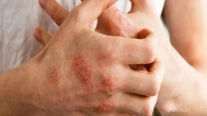 [FORUM] Teman-Teman, Kasih Tips untuk Merawat Kulit Eksim, Please!