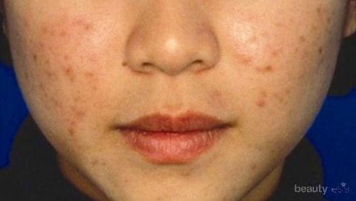 [FORUM] Cara Menghilangkan Bekas Jerawat Dong Please Dear