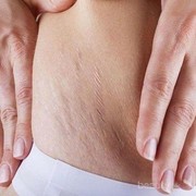 [FORUM] Bagi tips ampuh dan aman buat ngilangin strech mark dong Ladies!