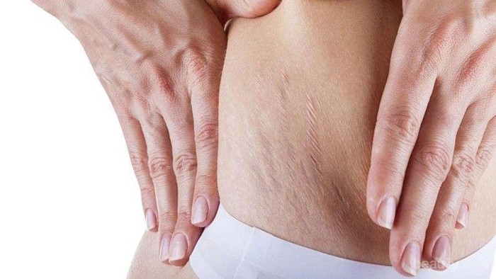[FORUM] Bagi tips ampuh dan aman buat ngilangin strech mark dong Ladies!