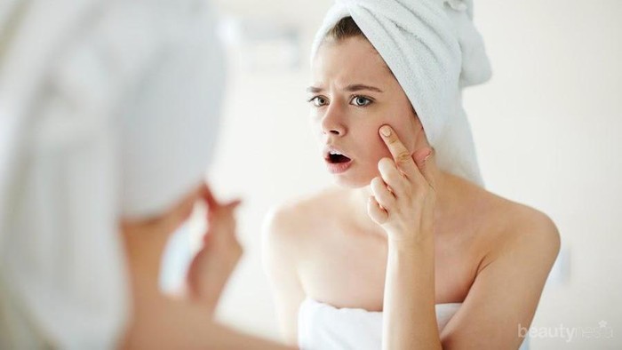 Wow! Bekas Jerawat Hilang Hanya dalam Satu Hari? Ini Caranya!