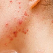 [FORUM] Kalau lagi jerawatan, boleh gak sih facial?