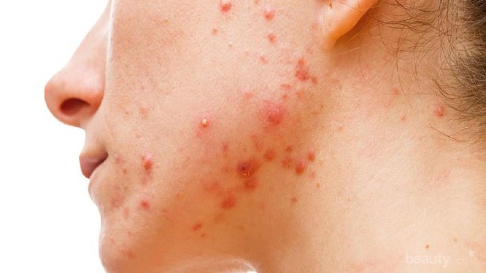 [FORUM] Kalau lagi jerawatan, boleh gak sih facial?