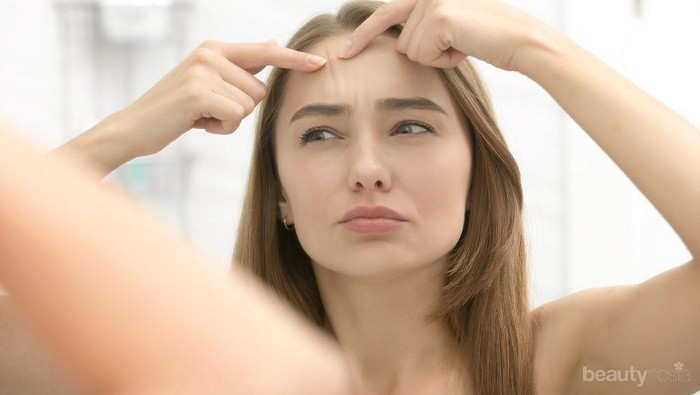 Apakah Jerawat Kamu Timbul Disebabkan Oleh Hormon? Cek Ciri-cirinya di Sini!