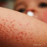 [FORUM] Rekomendasi Obat untuk yang terkena Biduran