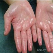 [FORUM] Telapak tangan sering berkeringat, adakah yang mengalaminya?