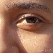 Susahnya menghilangkan jerawat batu di wajah yang sudah tahunan....