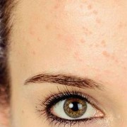 #FORUM Gimana Sih Cara Menghilangkan Bruntusan di Wajah?