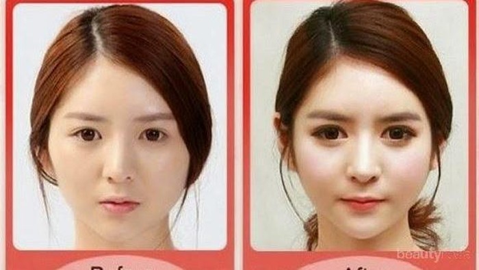 [FORUM] Plastic Surgery sebenernya sah-sah aja ga sih guys?
