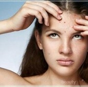 [FORUM] Hi girls, jerawat di dahi biasanya kalian ngilanginnya gimana?