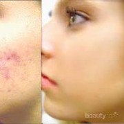 #FORUM Rekomendasi Obat Penghilang Jerawat..