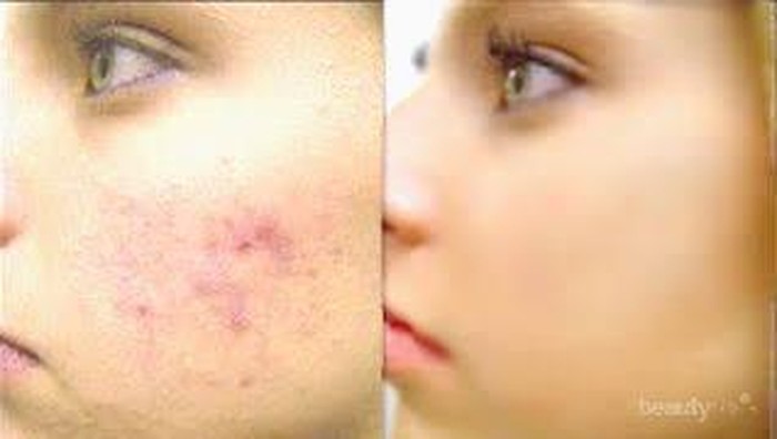 #FORUM Rekomendasi Obat Penghilang Jerawat..