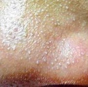 #FORUM Gimana sih caranya buat ngatasin komedo? Ada ga sih skincare yang bisa ngatasin komedo?