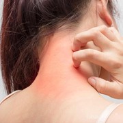 [FORUM] Kamu alergi makanan apa aja?