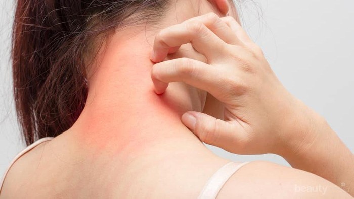 [FORUM] Kamu alergi makanan apa aja?