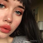 Pro Kontra Penggunaan Alkohol Pada Wajah Berjerawat!