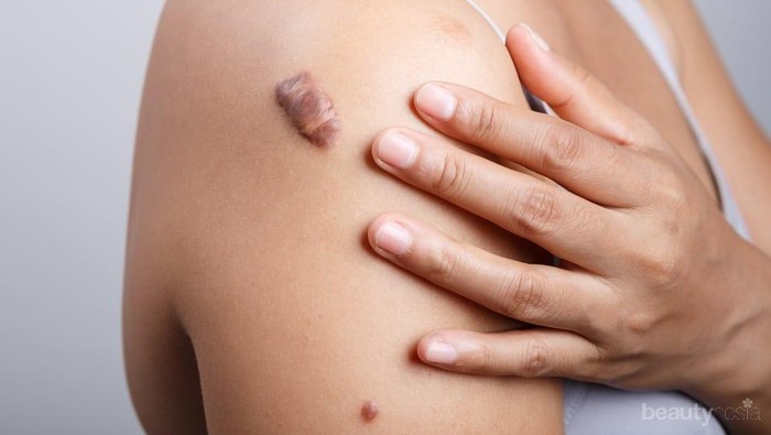 Mau Menyamarkan Keloid yang Mengganggu Penampilan? Manfaatkan 7 Bahan Alami Berikut Ini!